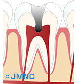 C3（歯髄まで進行した虫歯）